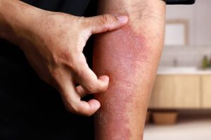 Healing Eczema & Identifying its Emotional Cause